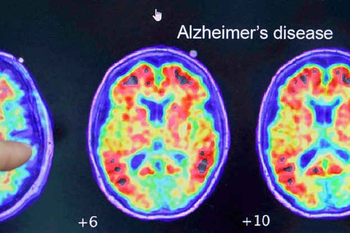 US to build $300 mln database to fuel Alzheimer's research 