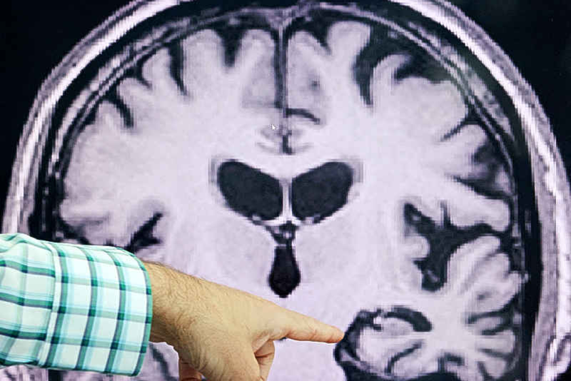 US firm Quest Diagnostics launches Alzheimer's blood test for consumers 